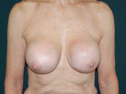 Breast Augmentation Revision (Breast Enlargement Repair) Before & After Patient #11584
