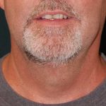 Liposuction of the Neck Before & After Patient #12042