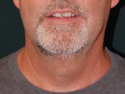 Liposuction of the Neck Before & After Patient #12042