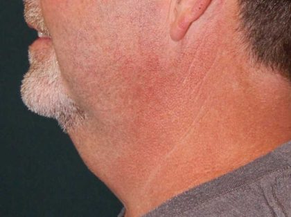 Liposuction of the Neck Before & After Patient #12042