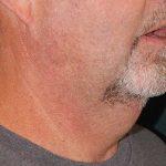 Liposuction of the Neck Before & After Patient #12042