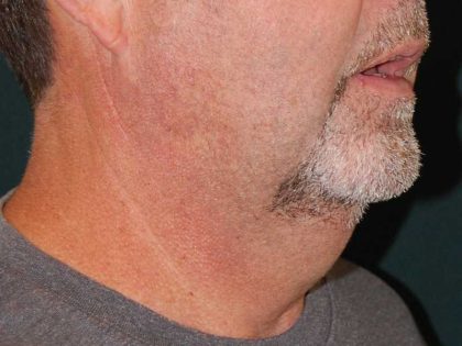Liposuction of the Neck Before & After Patient #12042