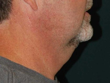 Liposuction of the Neck Before & After Patient #12042