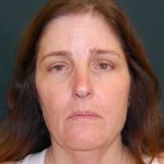 Facelift Before & After Patient #11792