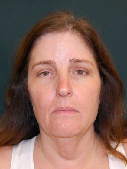 Facelift Before & After Patient #11792