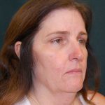 Facelift Before & After Patient #11792