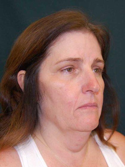 Facelift Before & After Patient #11792