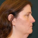 Facelift Before & After Patient #11792