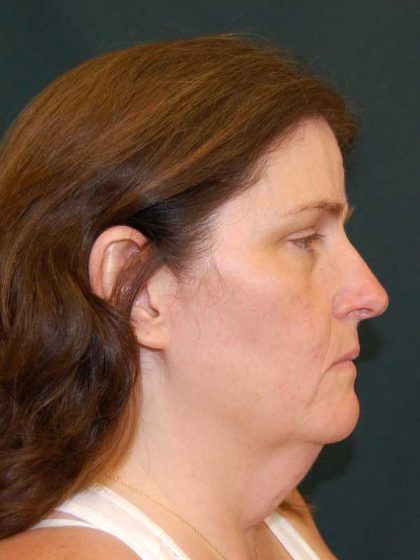 Facelift Before & After Patient #11792
