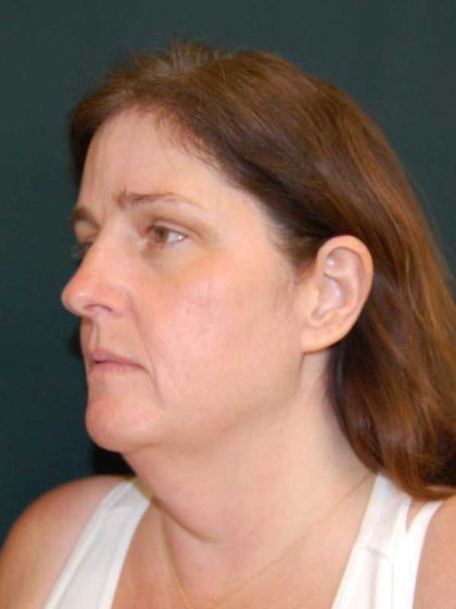 Facelift Before & After Patient #11792