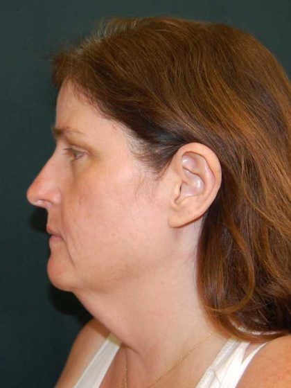 Facelift Before & After Patient #11792