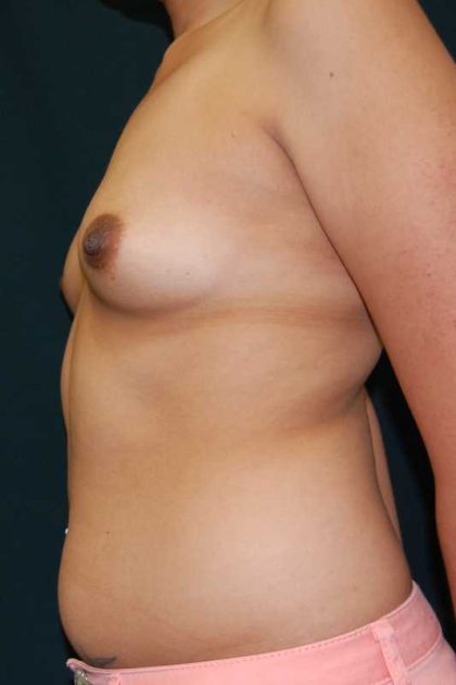 Breast Augmentation Before & After Patient #11531