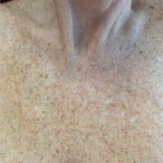 BroadBand Light (BBL™) Before & After Patient #13243