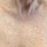 BroadBand Light (BBL™) Before & After Patient #13243