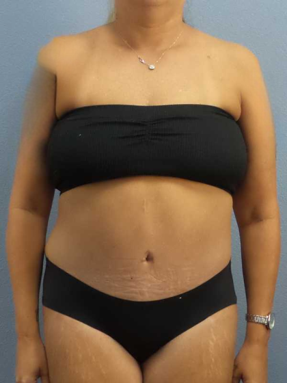 Abdominoplasty Before & After Patient #3594