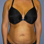 Abdominoplasty Before & After Patient #3775