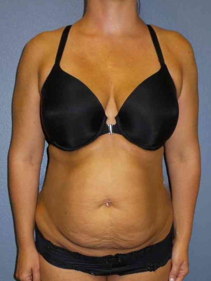 Abdominoplasty Before & After Patient #3775
