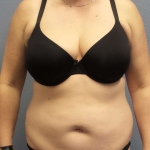 Abdominoplasty Before & After Patient #3550