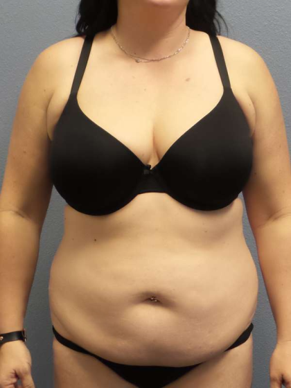 Abdominoplasty Before & After Patient #3550