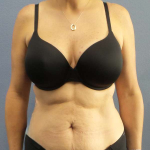 Abdominoplasty Before & After Patient #3471