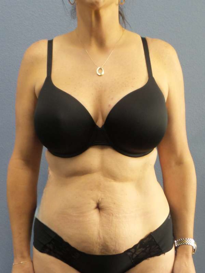 Abdominoplasty Before & After Patient #3471