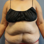 Abdominoplasty Before & After Patient #3437