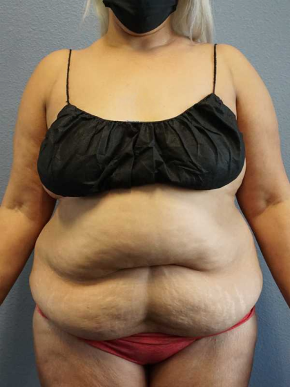 Abdominoplasty Before & After Patient #3437