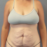 Abdominoplasty Before & After Patient #3409