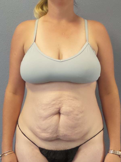 Abdominoplasty Before & After Patient #3409