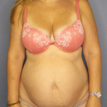 Abdominoplasty Before & After Patient #3350