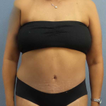 High BMI (Larger Patients) Surgery Before & After Patient #10380