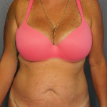 Abdominoplasty Before & After Patient #3272