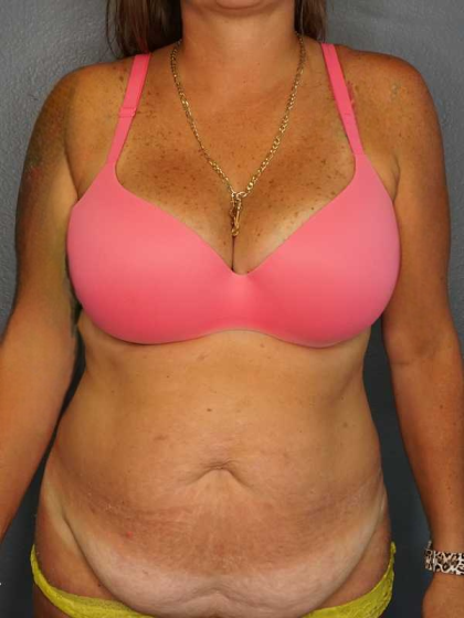 Abdominoplasty Before & After Patient #3272