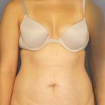 Abdominoplasty Before & After Patient #3236