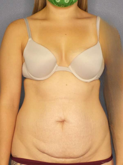 Abdominoplasty Before & After Patient #3236
