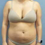 Abdominoplasty Before & After Patient #3225