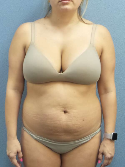 Abdominoplasty Before & After Patient #3225