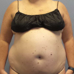 Liposuction Female Before & After Patient #11950