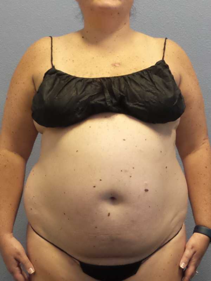 Liposuction Female Before & After Patient #11950