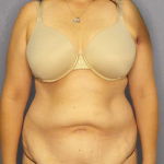 Abdominoplasty Before & After Patient #3188