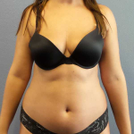 Liposuction Female Before & After Patient #11933
