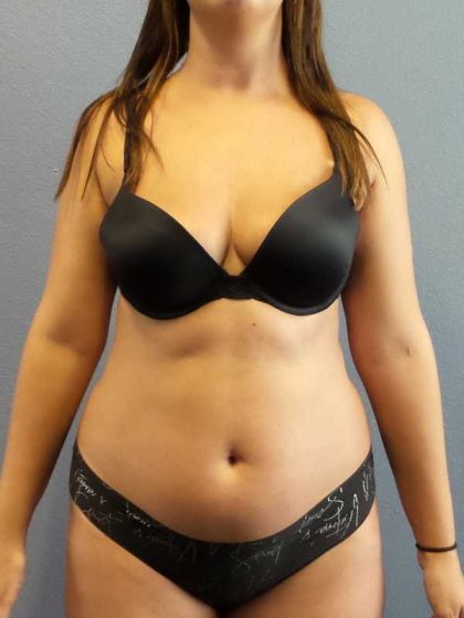 Liposuction Female Before & After Patient #11933