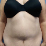 Abdominoplasty Before & After Patient #11131