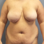 High BMI (Larger Patients) Surgery Before & After Patient #10431