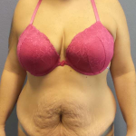 High BMI (Larger Patients) Surgery Before & After Patient #10378