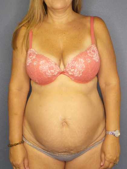 High BMI (Larger Patients) Surgery Before & After Patient #10329