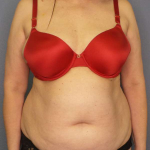 Liposuction Female Before & After Patient #7932