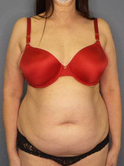 Liposuction Female Before & After Patient #7932