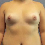 High BMI (Larger Patients) Surgery Before & After Patient #6042