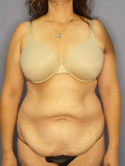 High BMI (Larger Patients) Surgery Before & After Patient #10272